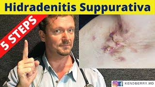 HYDRADENITIS SUPPURATIVA (5 Steps to Reverse HS)