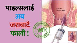 payals ko upachar rubber band ligation bata/piles home treatment/pails problem solution at home