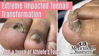 How to Pedicure on Extreme Impacted Toenail with Major Transformation 