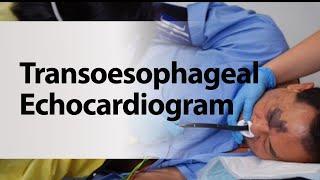 Transoesophageal Echocardiogram