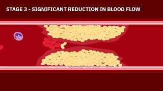 Coronary Artery Disease Animation