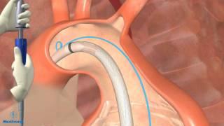 Thoracic Endovascular Aortic Aneurysm Repair in Dallas