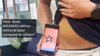 Jack's Experience Getting His Tattoo Removed by NAAMA the Leading Tattoo Removal Studio in London