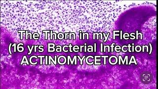 The Thorn in My Flesh(Actinomycetoma) 16yrs bacterial infection