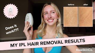 Lumi LASER HAIR REMOVAL Review & 1 Month Results! (ft. RoseSkinCo)