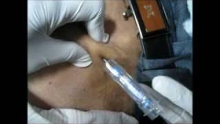 How To Give Goserelin Injection By Subcutaneous Mode?