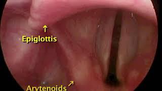 p.154. Intubation of a Child