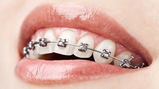 Foods to Eat and Avoid with Braces