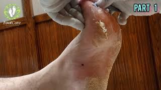 Dead skin Remove | pedicure |  | part 1 | Footcare33