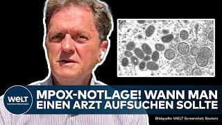 MPOX: WHO declares emergency! How high the risk is in Germany and when you should see a doctor