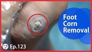 TOP MEDICAL PEDICURE Ep.123 - Foot Corn Treatment By Shaving and Dressing