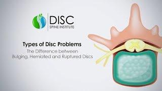 Types Of Disc Problems: What is the difference between a bulging, herniated and Ruptured Discs