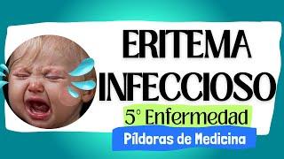 ¿Es Erupción o Algo Más Grave? Descubre los Misterios del Eritema Infeccioso o 5°Enfermedad