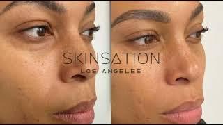 Botox injections in Los Angeles - Skinsation LA