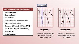 Advanced EKGs - Distinguishing VT from SVT with aberrancy