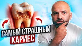 Самый ОПАСНЫЙ КАРИЕС! Как избежать Апроксимальный кариес? Чем опасен Контактный или Межзубной кариес