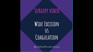 Why Did My Endometriosis Surgery Fail - Part 2: Wide Excision vs Coagulation for Endometriosis