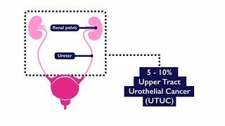 Upper Tract Urothelial Cancer