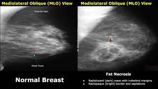 Mammography Normal Vs Abnormal Images | BI-RADS Classification | Breast Cancer & Other Diseases