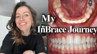 Finally Fixing my teeth! | My InBrace Journey | Before & After | Perfect Smile