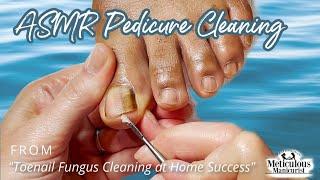 ASMR Pedicure Cleaning‍️Toenail Fungus Cleaning at Home Success