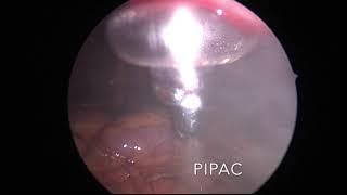 PIPAC treatment for advanced Peritoneal stage 4 cancers, Dr Sanjeev Kumar Oncologist Delhi NCR India