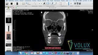 Volux - Tutorial OsiriX Lite parte 1 di 2