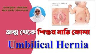 Umbilical Hernia II জন্ম থেকে শিশুর নাভি ফোলা II Dr. Samsun Nahar