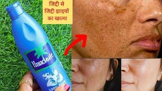 पुराने से पुराने झाइयों के दाग,काले धब्बे निशान हटाए 3दिनों में Cure Spots, Pigmentation झाइयां खत्म