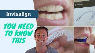 40 Invisalign tips you need to know