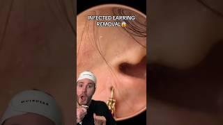 INFECTED EARRING REMOVAL! (follow for more) #beauty #skincare #beautytips #acne #skincareroutine
