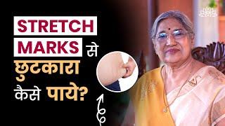 Stretch marks हटाने के सरल उपाय | How to remove Stretch Marks | Pregnancy | गर्भावस्था