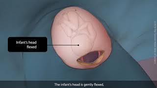 Primary vertex caesarean section (C-section) | TVASurg