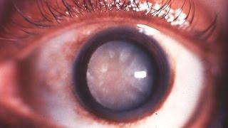 Лечение и последствия набухающей катаракты
