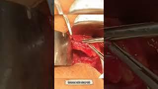 Bilateral Staghorn stone + ureter stone