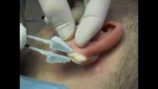 Cryotherapy of ear keloid.