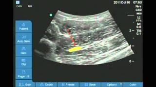 Ultrasound guided anterior sciatic nerve block