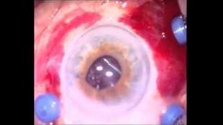 27-G vitrectomy. Офтальмохирург Шкворченко Д.О.