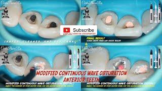 modified continuous wave obturation anterior teeth fast pack fast fill eighteeth pop dentistry