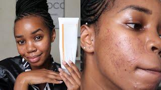 ACNE.ORG BENZOYL PEROXIDE TIPS FOR CLEAR SKIN