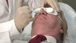 Laser Clearance of Facial Veins and Redness for Males