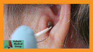 Chunky Earwax Removal | Auburn Medical Group