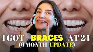 THIS IS HOW LIFE LOOKS LIKE WHEN HAVING BRACES | 6 MONTH UPDATE