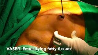 Man Boobs Surgery at Bliniq Cosmetic Surgery Centre l Dr Ashwani Kumar, Plastic Surgeon