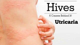 Urticaria Hives डाबर आउने समस्या के हो ? || Dr.Rupak Ghimire