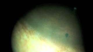 yag laser iridotomy for angle closure glaucoma in a brown iris