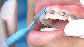 Tutorial Bersihkan behel (kawat gigi) dengan sikat Interdental