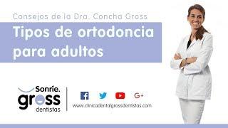 Qué tipos de ortodoncia existen para adultos - Clínica Dental Gross Dentistas en Málaga