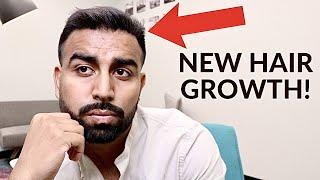 4 MONTH TURKEY HAIR TRANSPLANT UPDATE | NEW HAIR GROWTH!