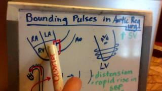 Bounding Pulses in Aortic Regurgitation